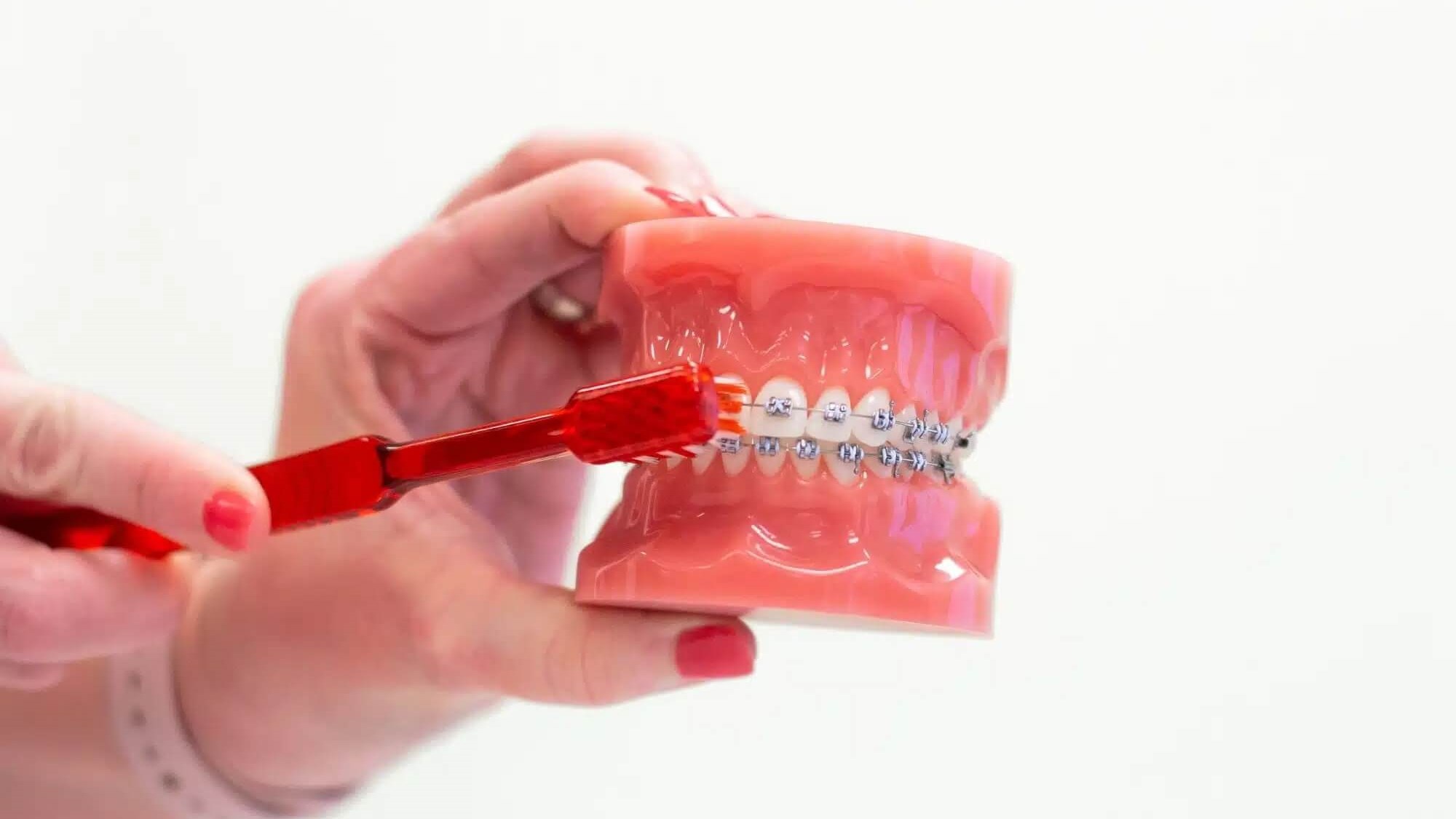 Life with Braces